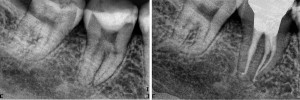 molare in necrosi prima e dopo la cura