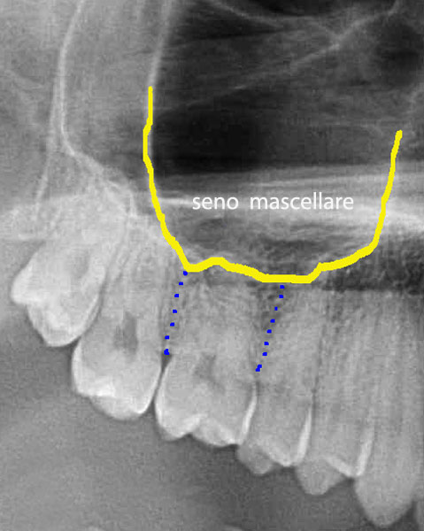 05-osso-mascellare-normale-in-presenza-dei-molari