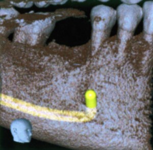 Ricostruzione 3D della mandibola