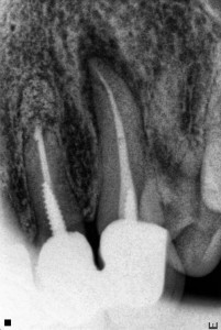 granuloma in dente devitalizzato