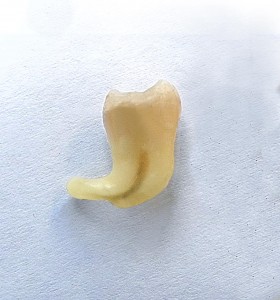dente complesso