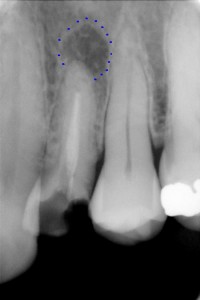 dente devitalizzato con granuloma