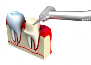 preprazione del dente da ricoprire